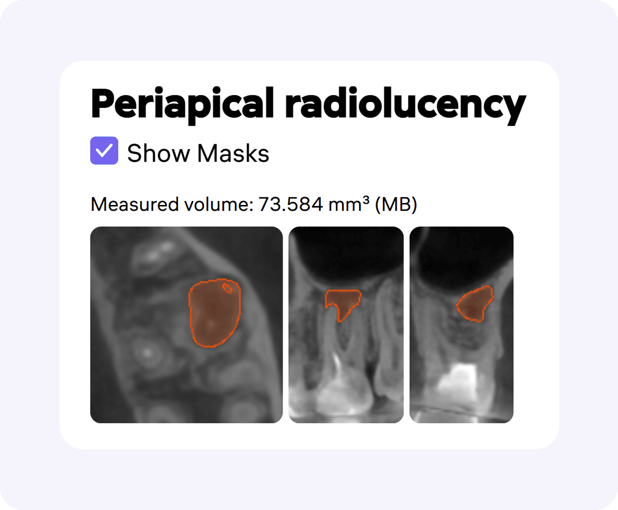 [object Object], with automatic measurement of periapical lesion volume.