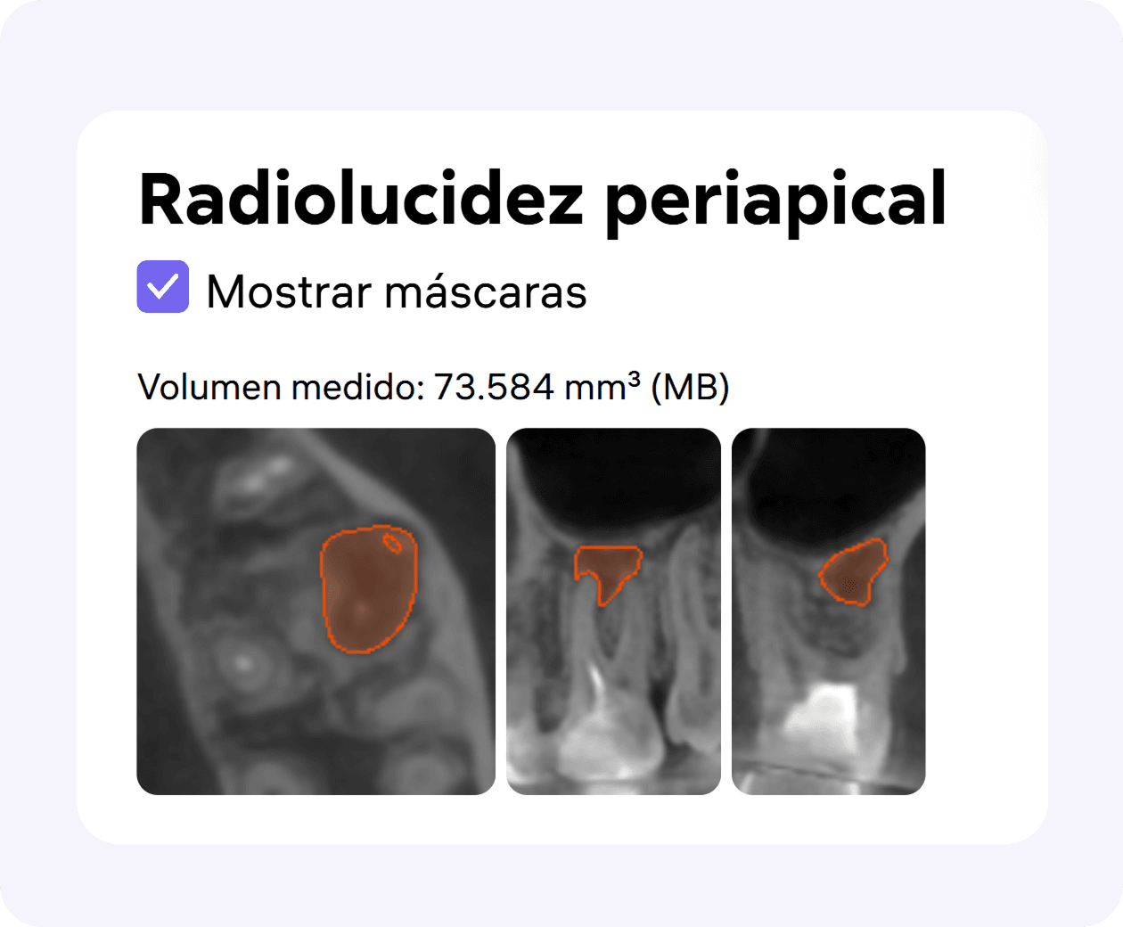 [object Object], con medición automática del volumen de la lesión periapical.