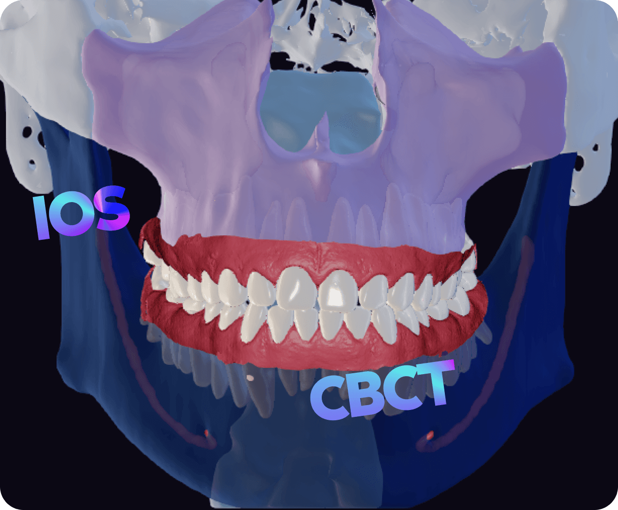 [object Object], Creation of combined tooth models based on CBCT and intraoral scans.