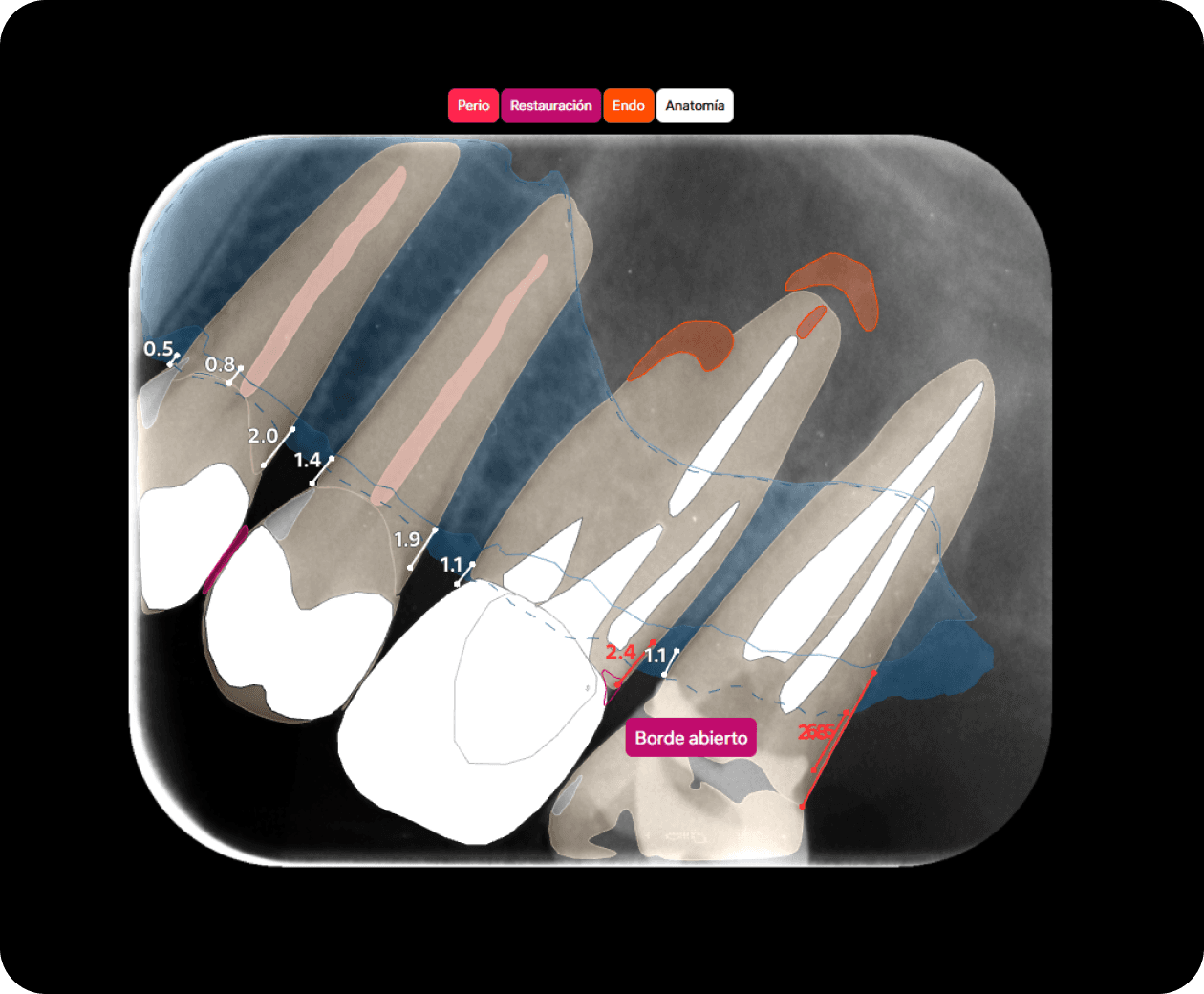 [object Object], El etiquetado de patologías se divide en 4 grupos: Endo, Restauración, Perio y Anatomía. Puede resaltar las condiciones cambiando entre abarque. La categoría ‘Anatomía’ marca gráficamente las estructuras anatómicas y los tratamientos previos.