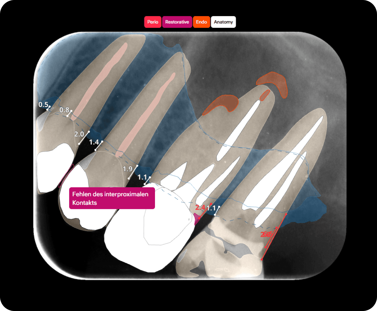 [object Object], Die Pathologiekennzeichnung ist in 4 Gruppen unterteilt: Endo, Restaurativ, Perio, Anatomie. Sie können Bedingungen hervorheben, indem Sie zwischen diesen Gruppen wechseln. In der Kategorie „Anatomie“ werden anatomische Strukturen und frühere Behandlungen grafisch markiert.