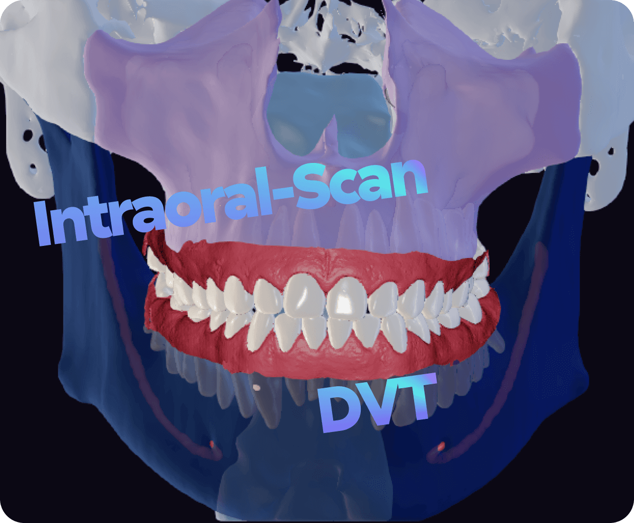 [object Object], Erstellung von kombinierten Zahnmodellen auf der Grundlage von DVTs- und intraoralen Scans.
