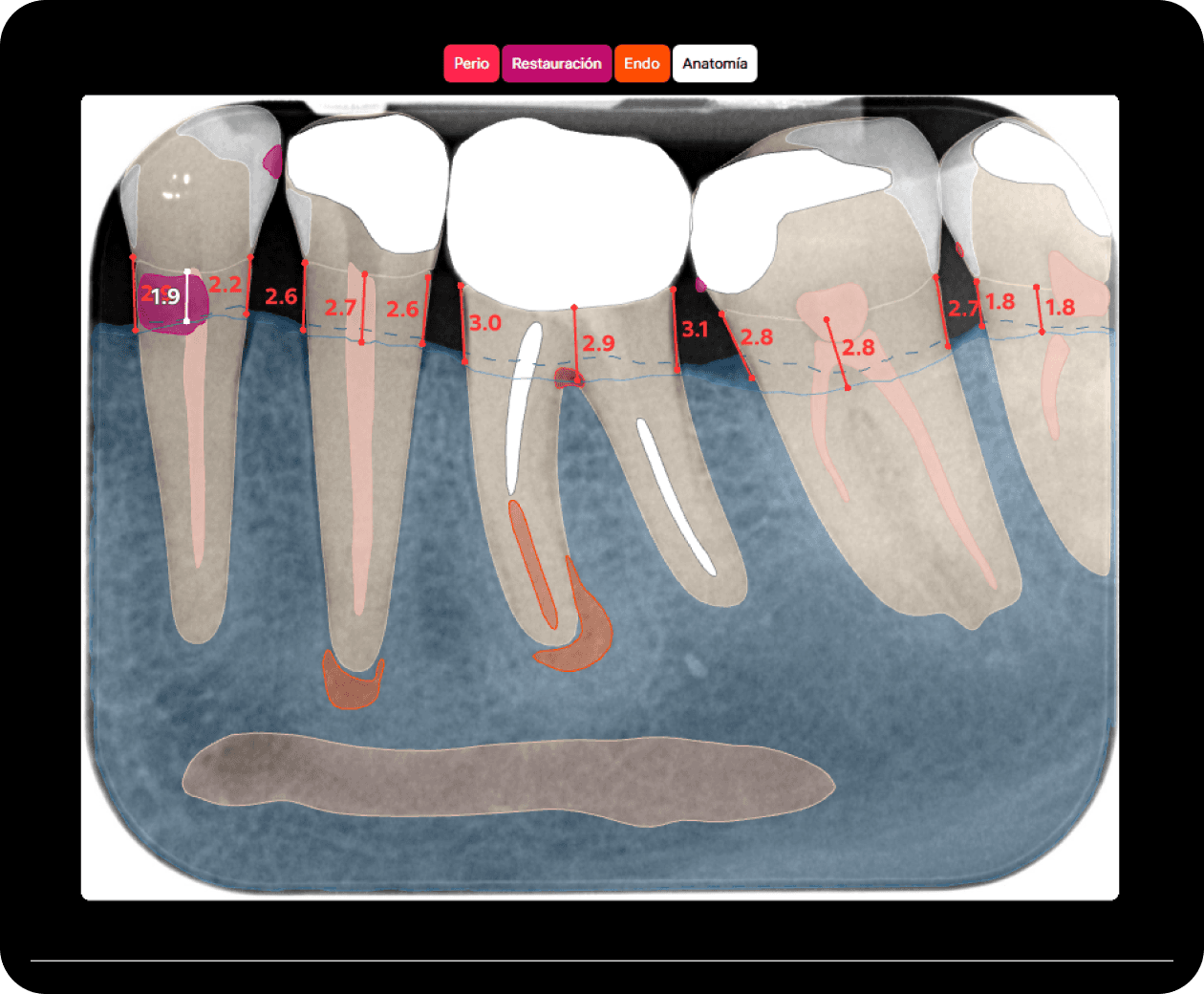 [object Object], de las caras vestibular y oral de la cresta alveolar.