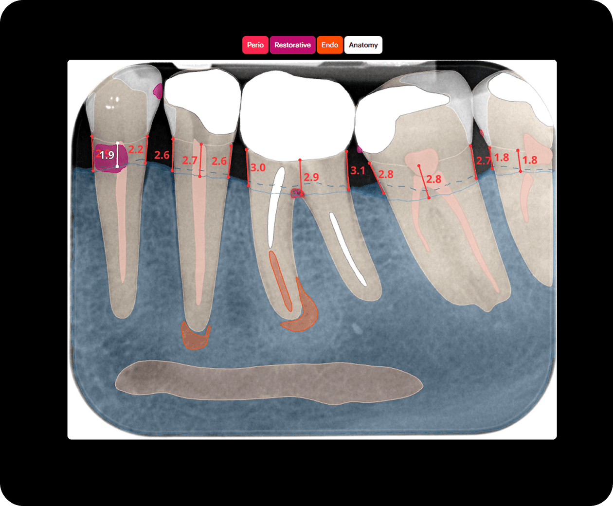 [object Object], der Funktion der vestibulären und oralen Seite des Alveolarkamms.