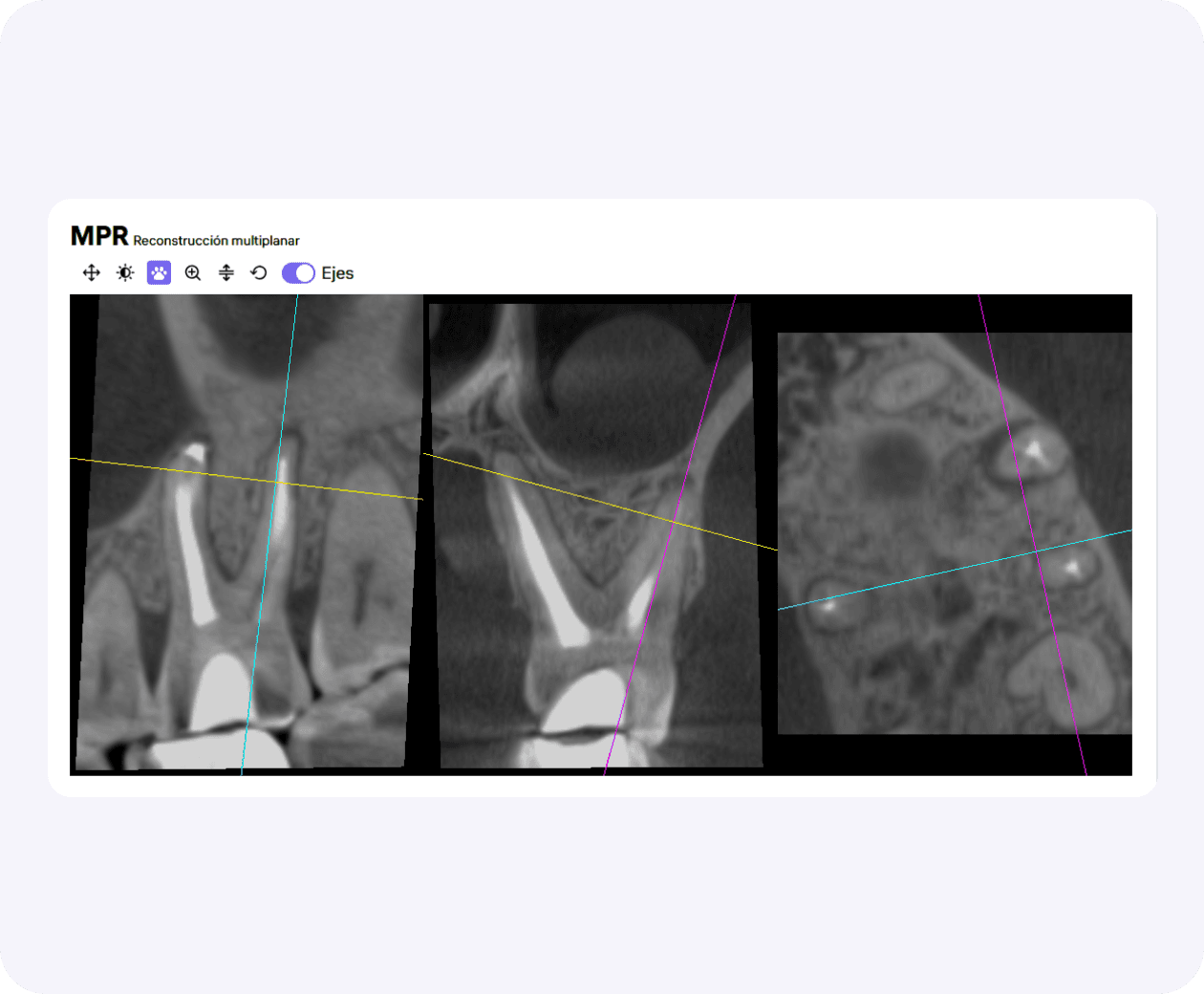 [object Object], de Diagnocat está integrada en el informe radiológico y permite el análisis de la región de interés seleccionada.