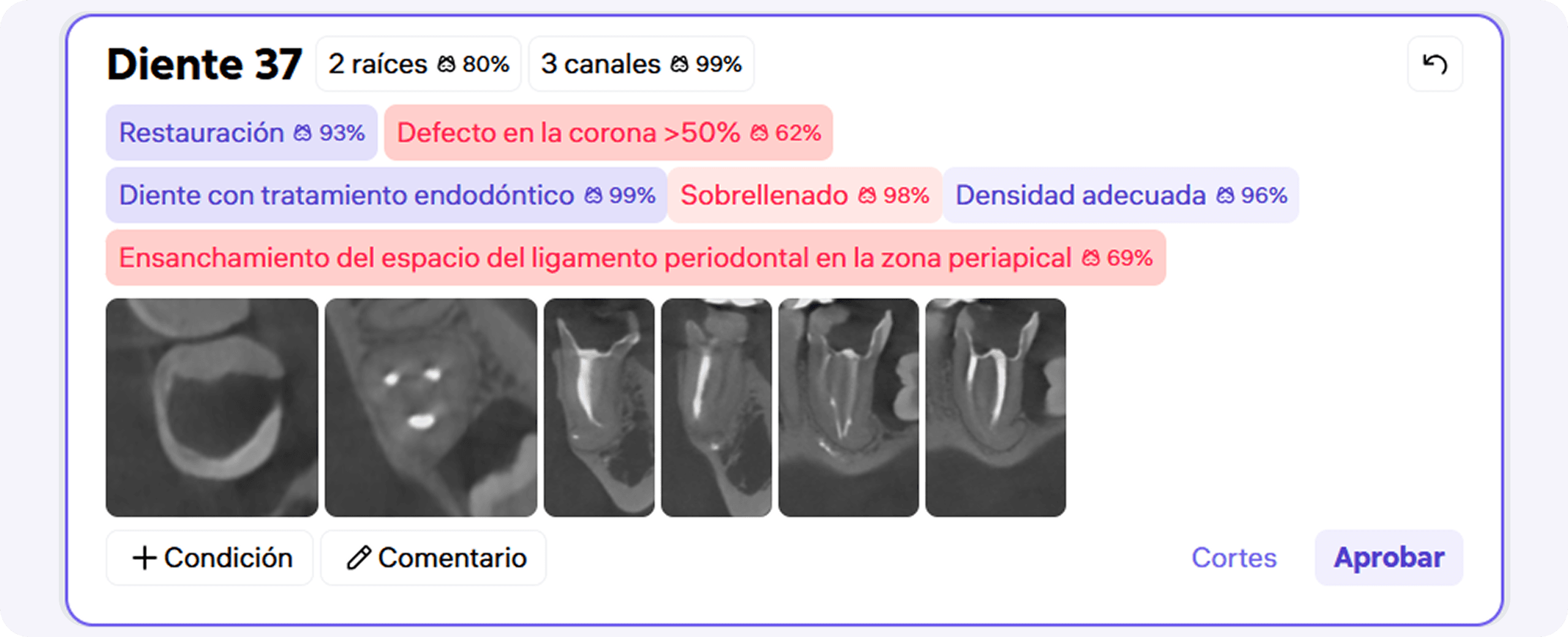 [object Object], determina automáticamente la magnitud de los defectos coronales dentales, lo que permite establecer indicaciones precisas para el tratamiento prostodóntico y simplifica la comunicación con el paciente.