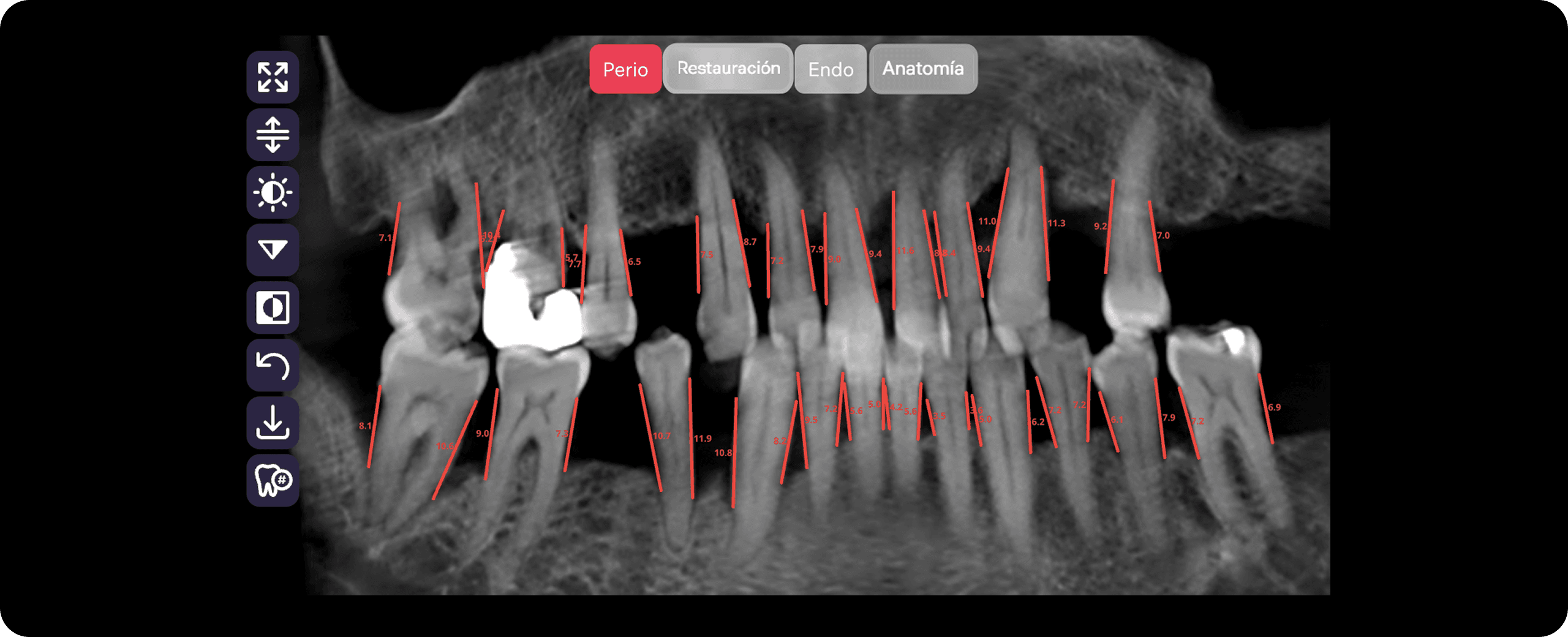 [object Object], en milímetros mediante CBCT..