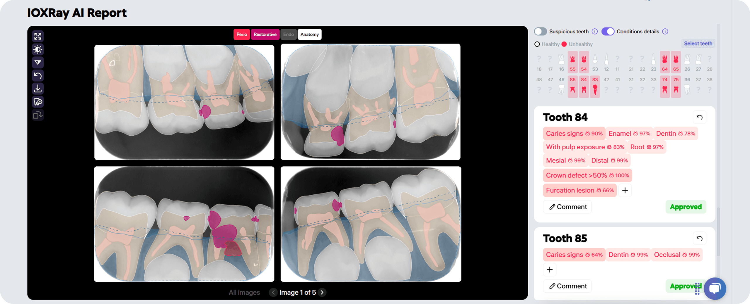Diagnocat detects early signs of caries in primary teeth and helps identify potential complications.