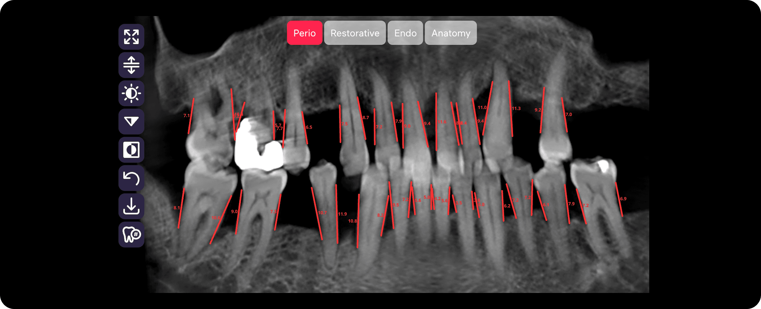 [object Object], Knochenverlusts in Millimetern auf der DVT.