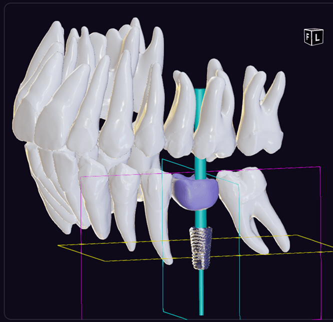 Implant report
