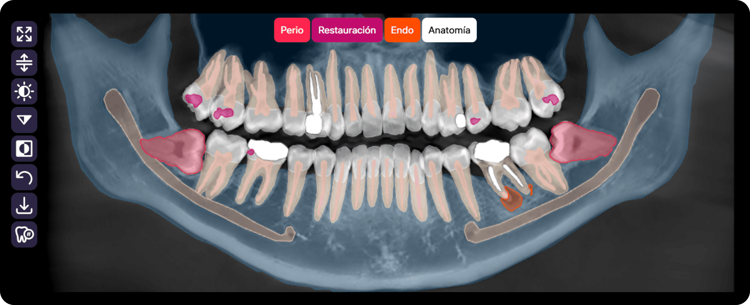 Diagnocat genera automáticamente una reconstrucción panorámica de alta calidad a partir de los datos CBCT, mostrando de forma clara las condiciones detectadas y las estructuras anatómicas.