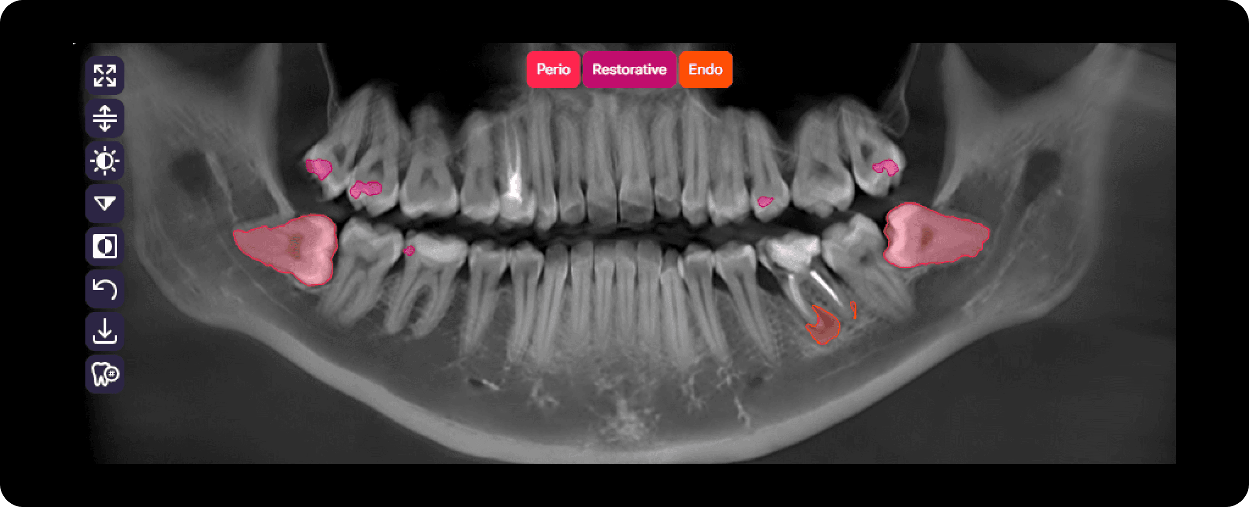 Diagnocat automatically creates a high-quality panoramic reformat from CBCT data, with clear visualization of detected conditions.
