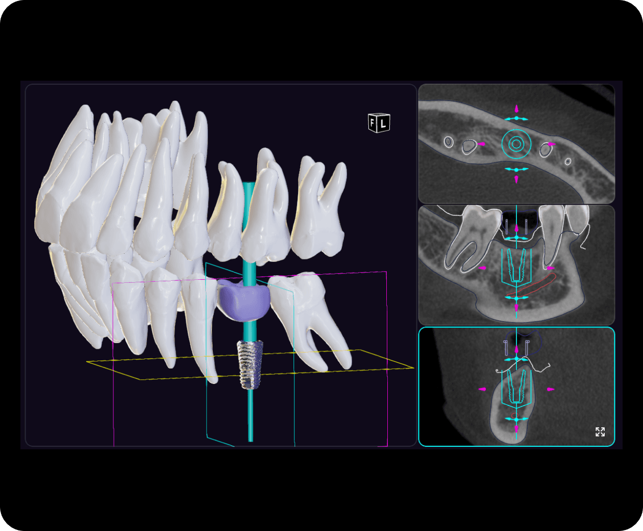 [object Object], die optimale Position des Implantats und der Arzt kann sie bei Bedarf anpassen.