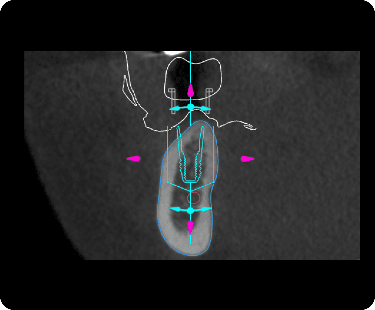 [object Object], eine „Sicherheitszone“ um das Implantat und erleichtert so die Positionierung des Implantats.