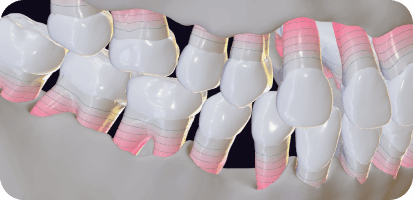 AI and Gum disease