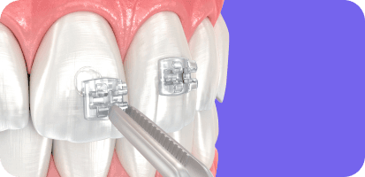 Revolutionising Orthodontics with AI