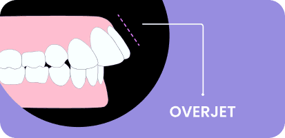 What is an Overjet in Teeth?
