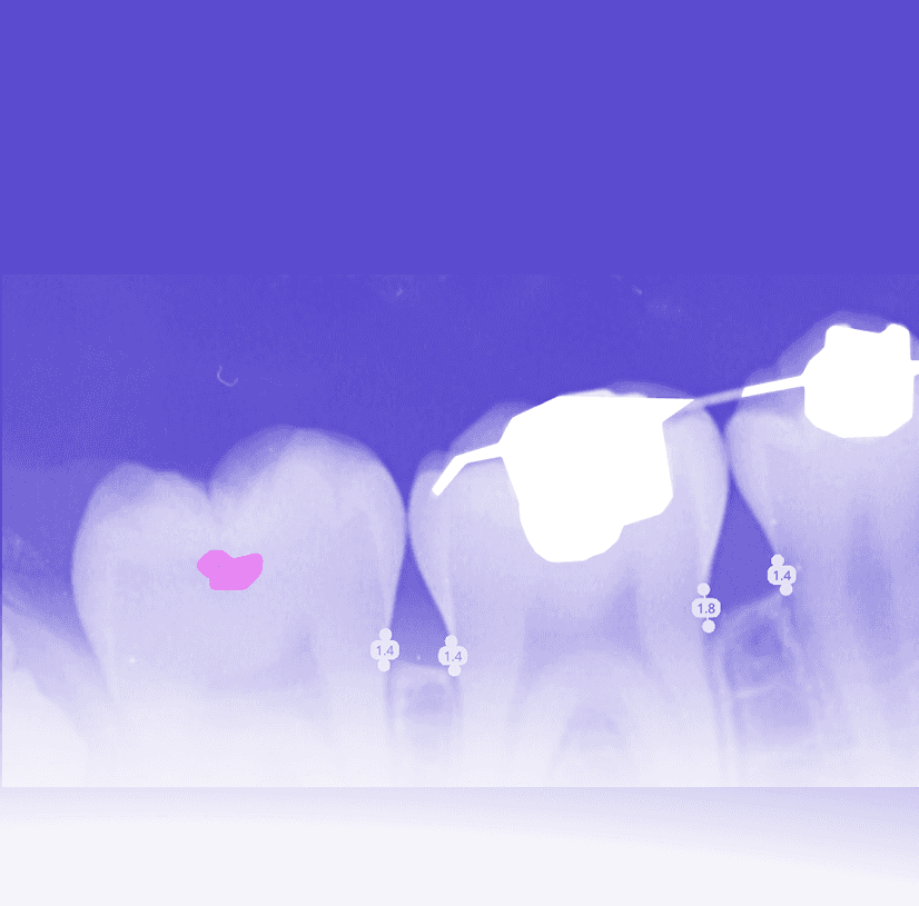 Caries Screening on Intraoral Radiographs