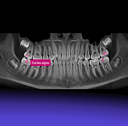 Precise Caries Detection with Depth and Surface Assessment