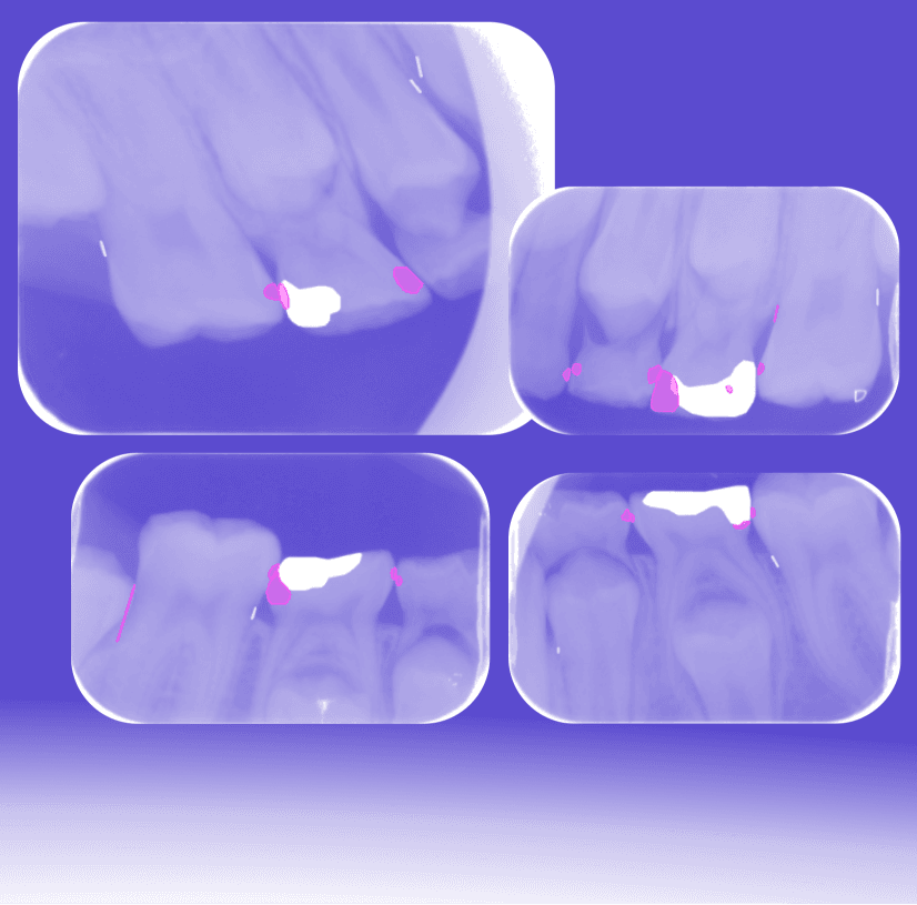 Caries Screening in Primary and Permanent Teeth