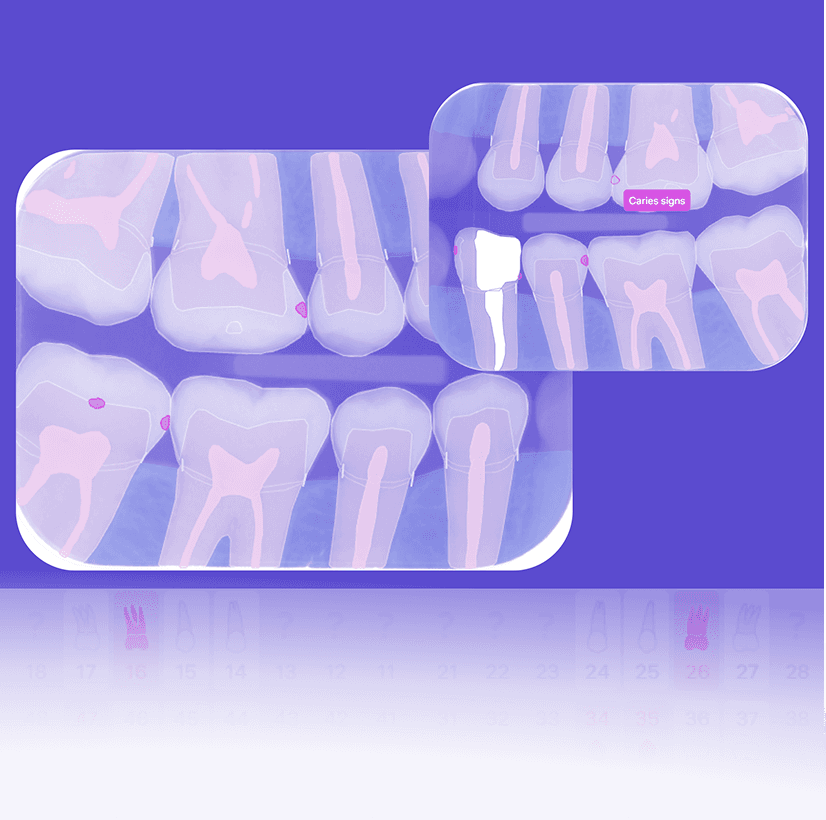 Bitewing X-Ray: Precision Caries Detection