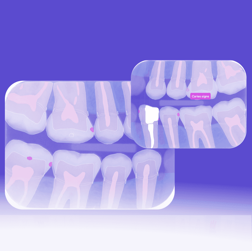 Early Detection of Caries Signs