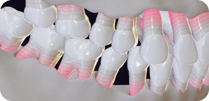 AI and Gum disease