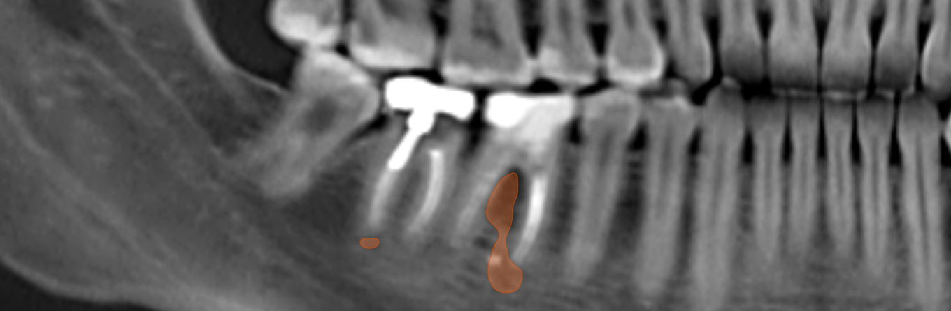 A Second Set of Eyes: Using Diagnocat's FDA-Cleared CBCT Tools in Endodontic Practice