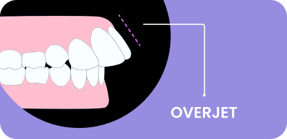 What is an Overjet in Teeth?