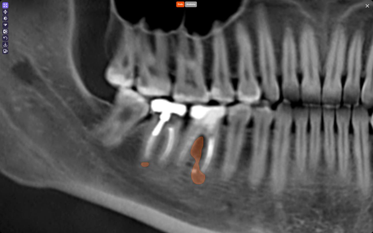 A Second Set of Eyes: Using Diagnocat's FDA-Cleared CBCT Tools in Endodontic Practice