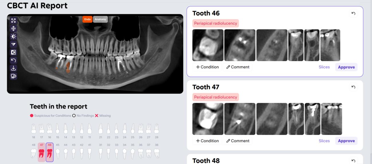 Diagnocat CBCT AI Report interface: a panoramic view, a color-coded tooth chart marking teeth 46 and 47 as suspicious, and per-tooth report cards flagging periapical radiolucency.