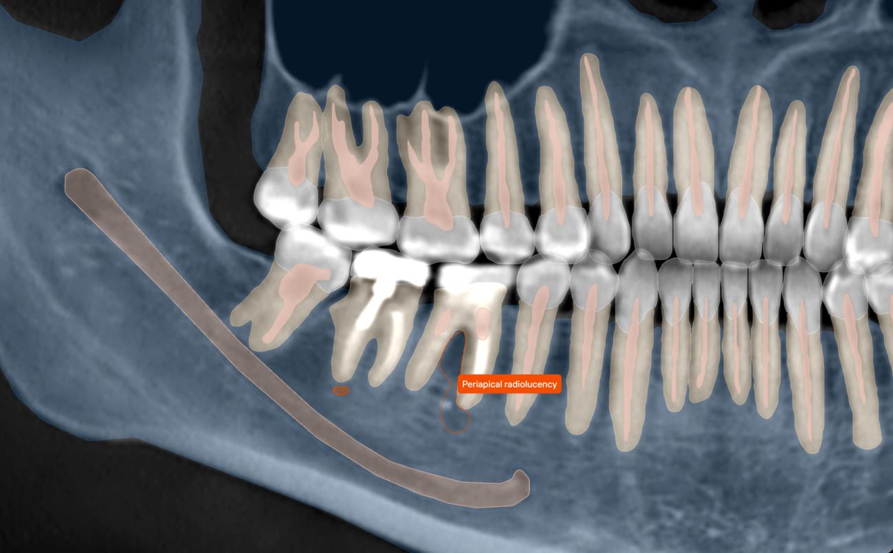 Diagnocat 3D Viewer showing segmented, color-coded maxillofacial anatomy with a periapical radiolucency tag near the roots of tooth #46.