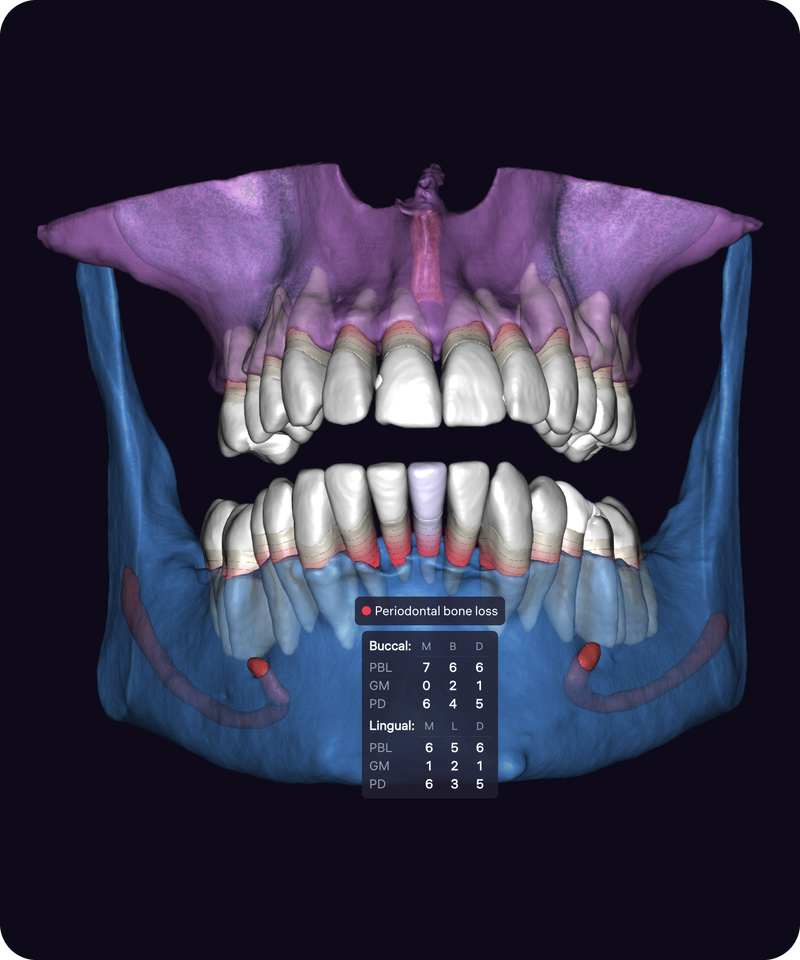 Clinical case with CBCT and an intraoral scan, with gingiva hidden to reveal bone defects