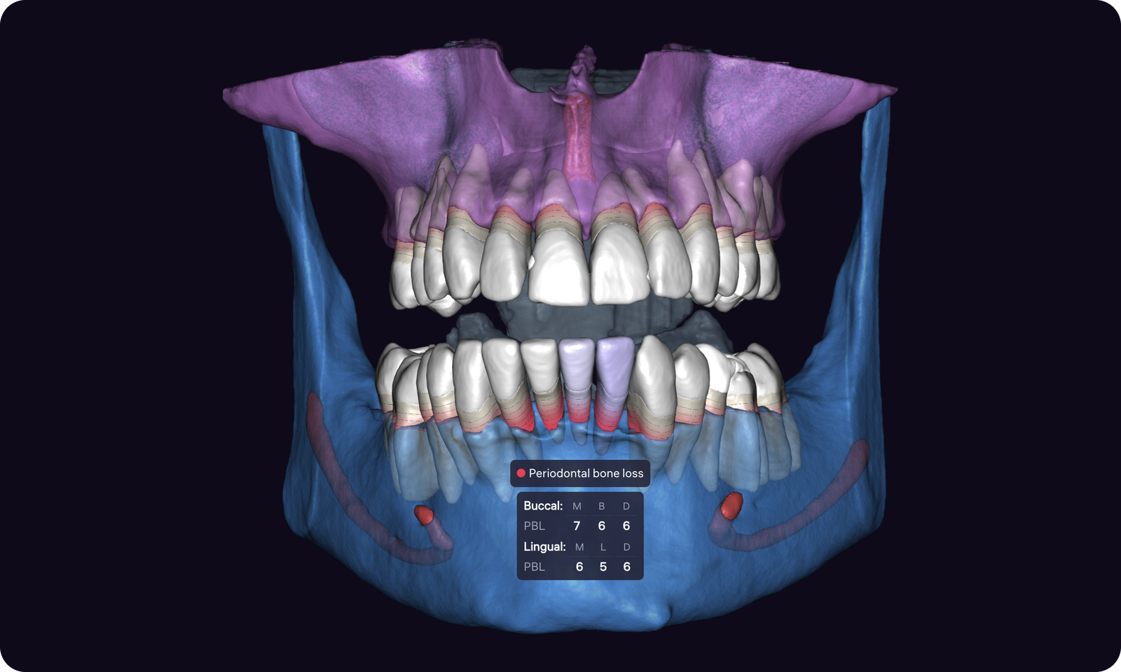 Clinical case based on CBCT only, without an intraoral scan