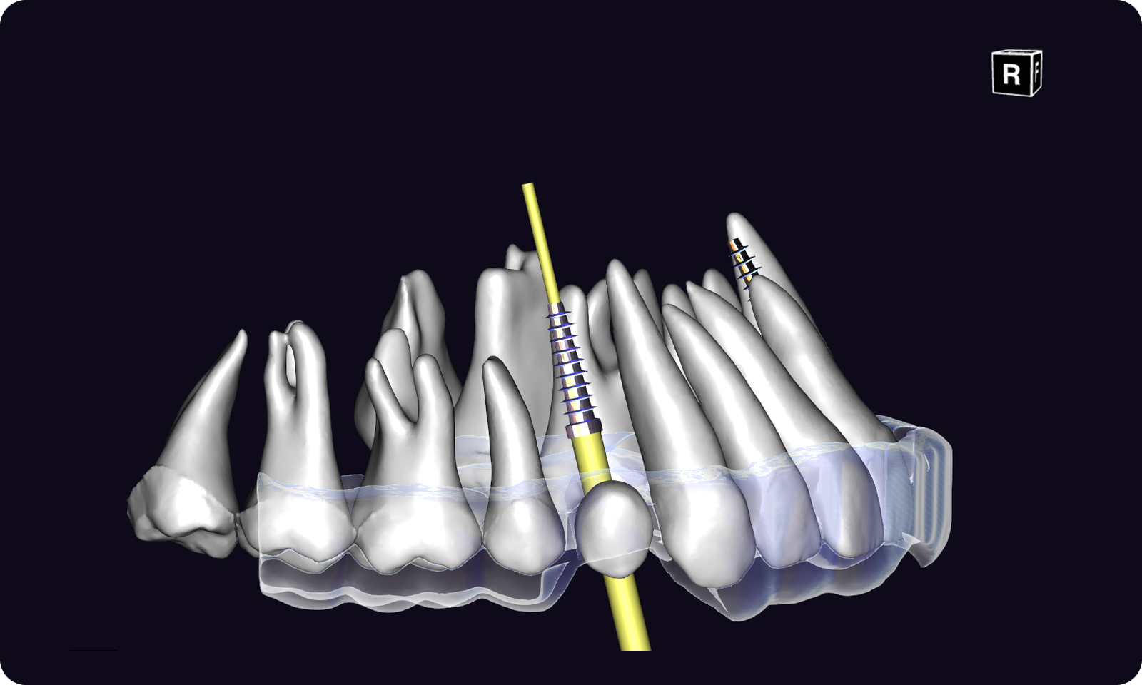 Surgical guide generated automatically for implant planning