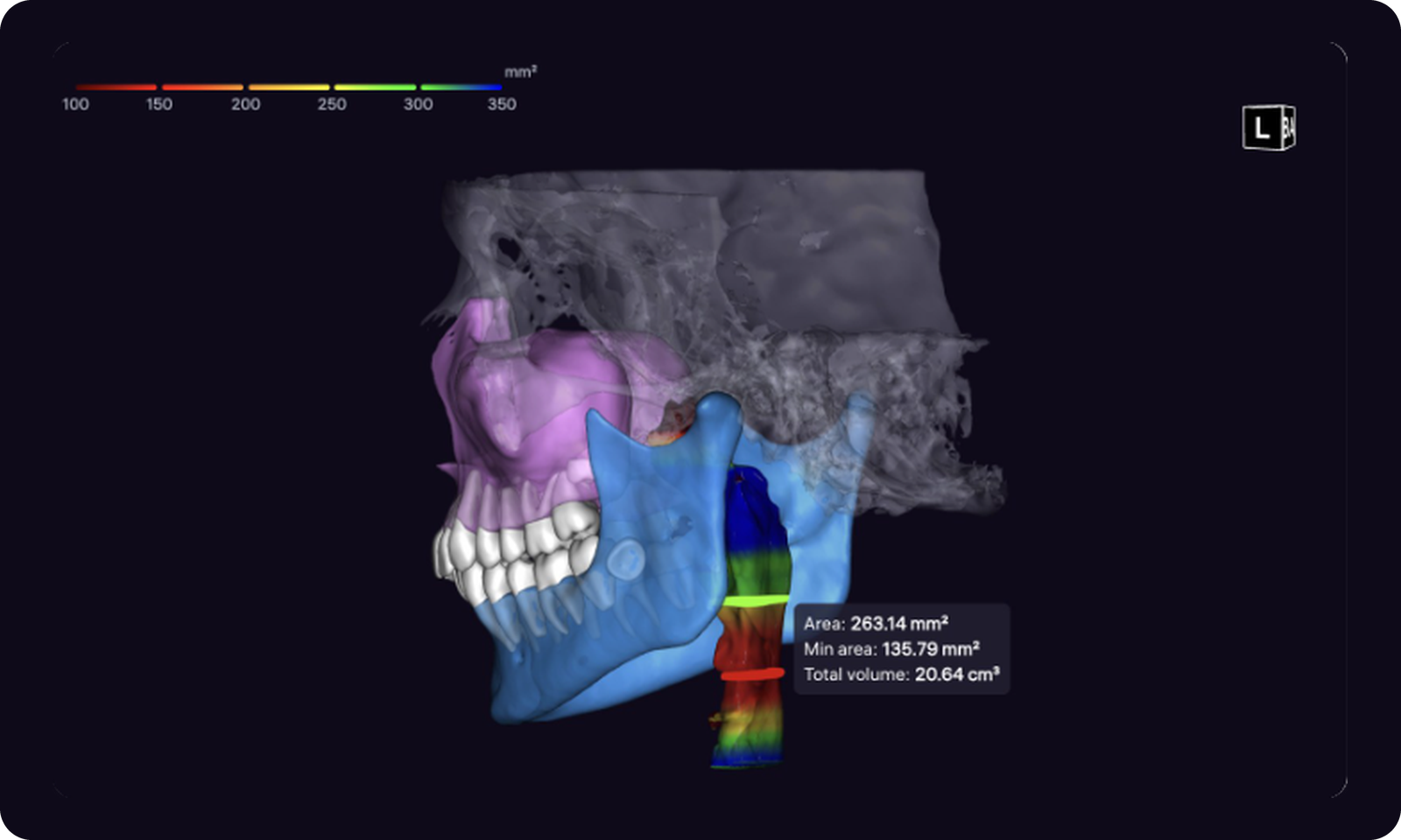 3D report: airways colored by cross-sectional area, with the measurements tooltip