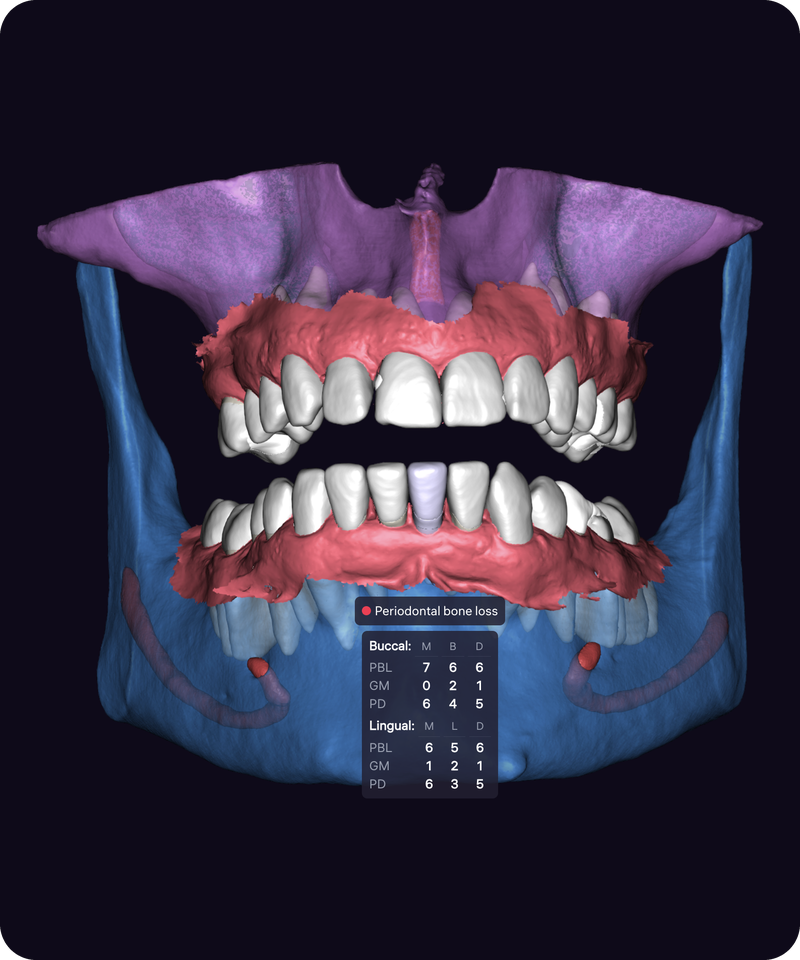 Clinical case with CBCT and an intraoral scan, with gingiva visible