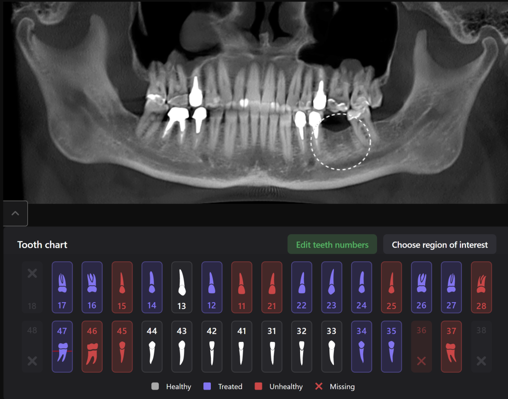 Case study - Implant planning supported with Diagnocat AI 1