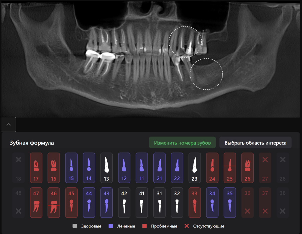 Планирование имплантации с помощью модулей Diagnocat 1