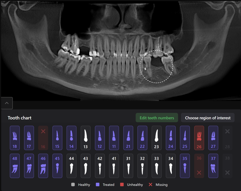 Case study: Implant planning for missing 36 (Universal 19) 1