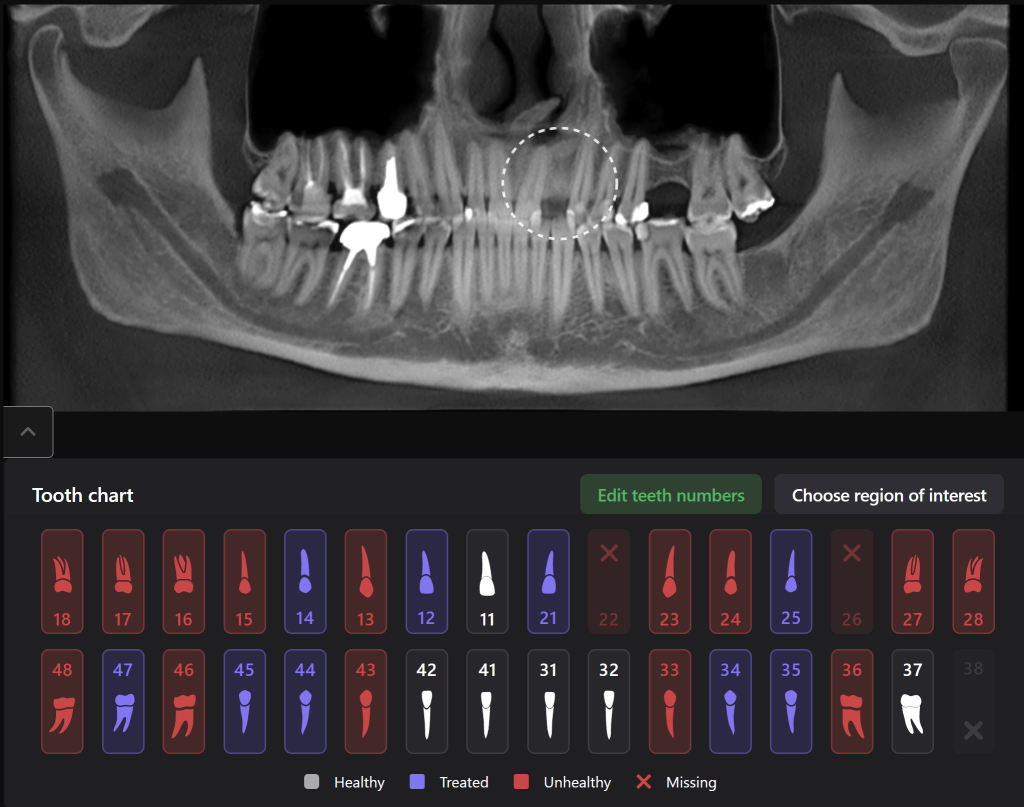 Aesthetic zone implant plan 1