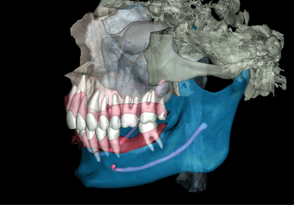 Case study - Implant planning supported with Diagnocat AI 3