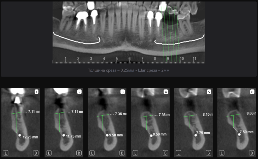 Случай из практики - планирование имплантации вместе с ИИ Diagnocat 3