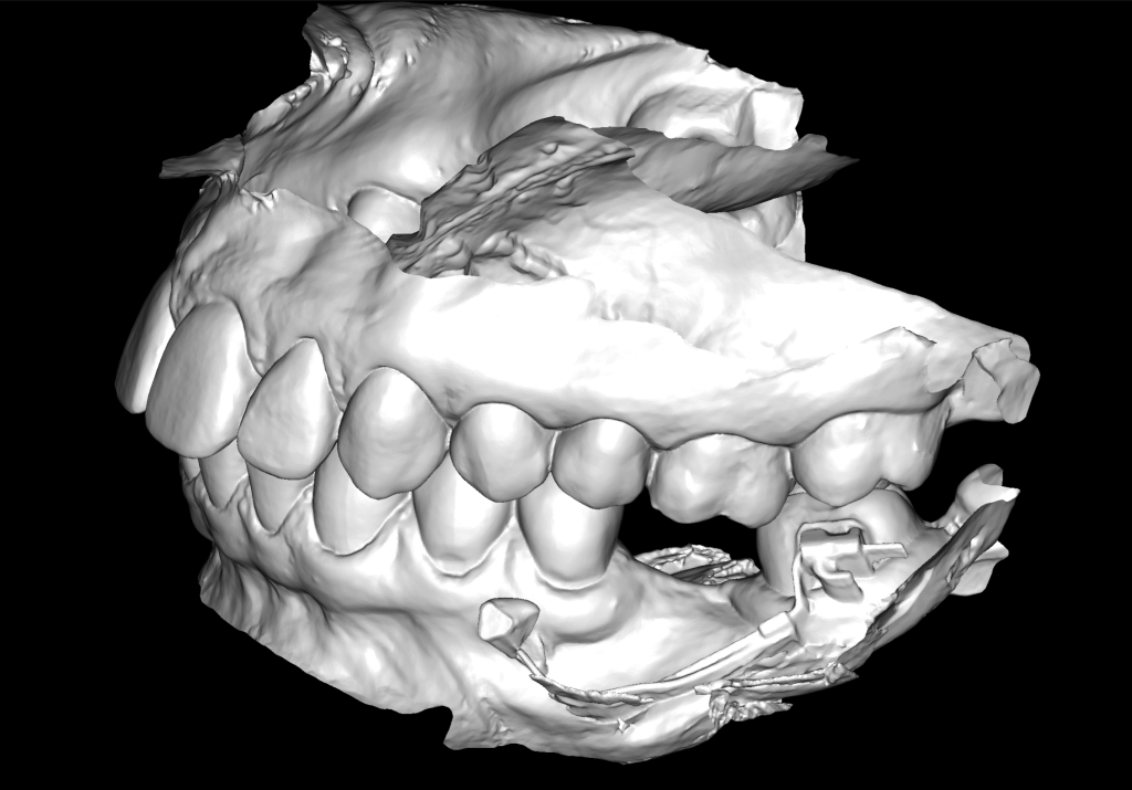 Case study: Implant planning for missing 36 (Universal 19) 3