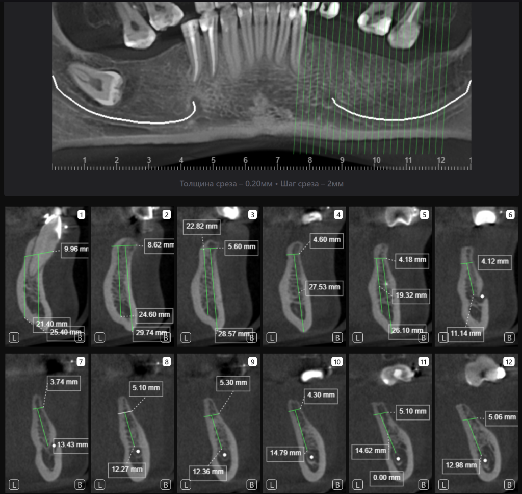 Пример из практики - планирование реконструкции альвеолярного гребня вместе с Diagnocat 3