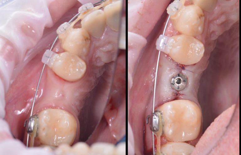 Case study - Reconstruction of the alveolar ridge using Diagnocat AI