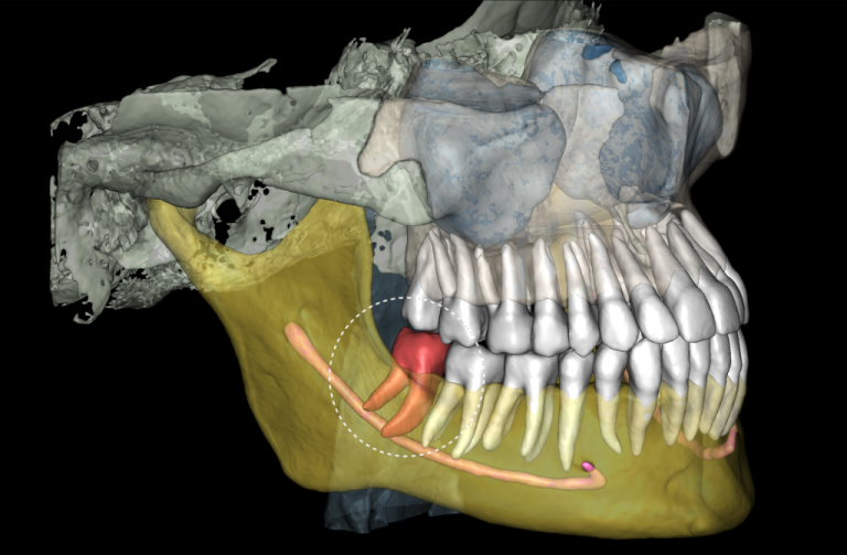 Case study - Treatment plan for atraumatic extractions