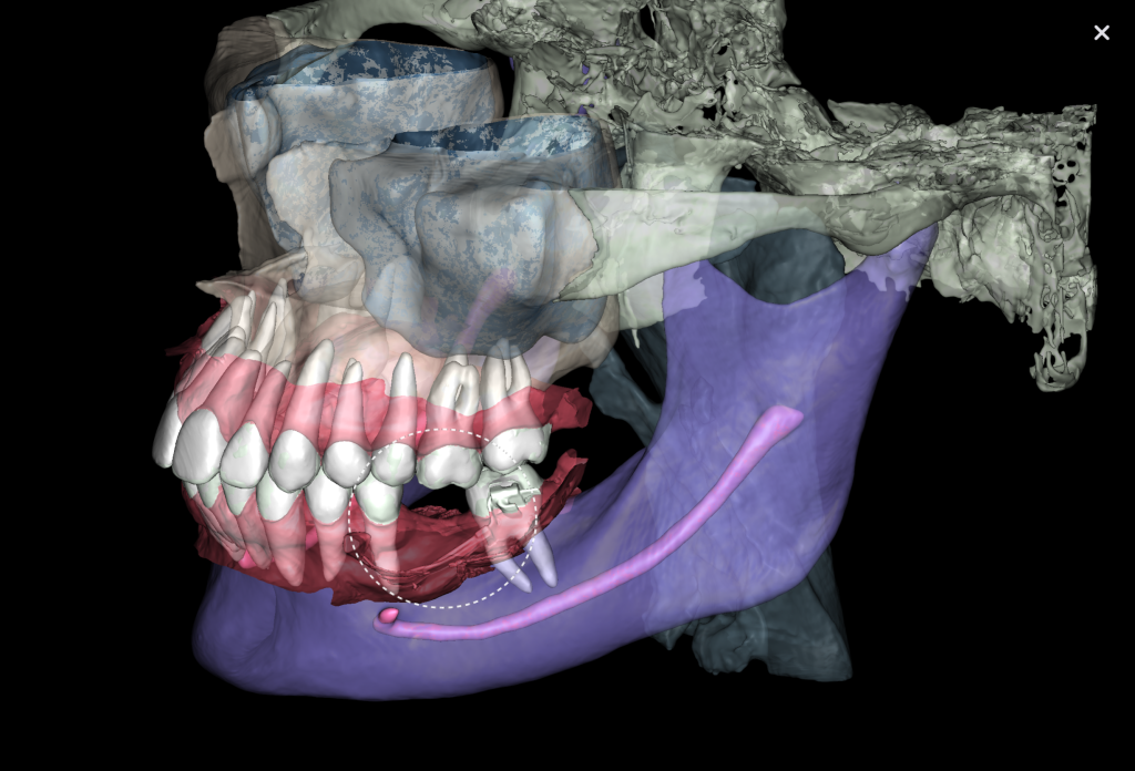 Case study: Implant planning for missing 36 (Universal 19) 5