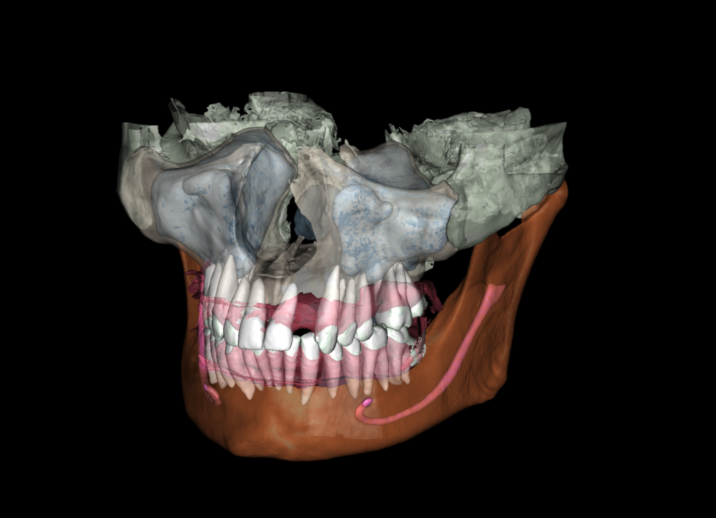 Aesthetic zone implant plan 5