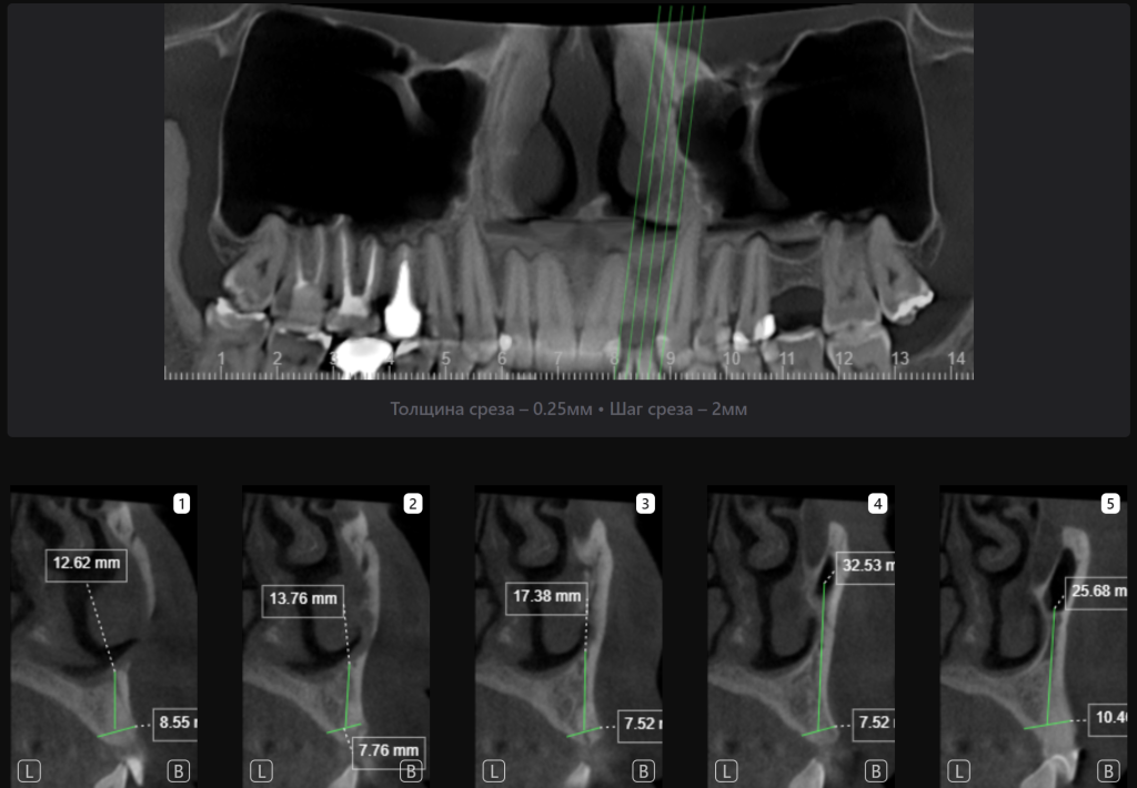 Планирование имплантации зуба в эстетически важной зоне 5